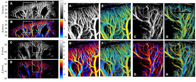 Ultrasound localization microscopy-derived super-resolution images comparing the intrarenal microvasculature of a person with autosomal dominant polycystic kidney disease and an age- and sex-matched control. The figure includes morphology, bidirectional flow, flow velocity and flow direction maps, demonstrating altered cortical microvascular organization and vascular flow patterns in autosomal dominant polycystic kidney disease compared with the control kidney.