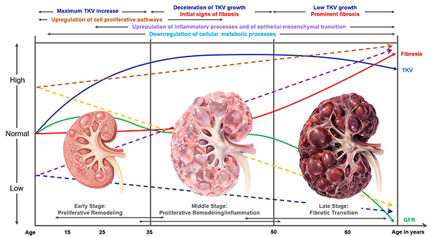 Conceptual illustration of autosomal dominant polycystic kidney disease progression over time. Three kidneys representing early, middle and late stages of disease are shown alongside curves depicting changes in total kidney volume, kidney function, fibrosis, inflammatory signaling, proliferative pathways and metabolic activity. The figure illustrates overlapping biological phases during disease progression, including proliferative remodeling, inflammatory and injury-repair responses, and late fibrotic remodeling associated with accelerated decline in kidney function.