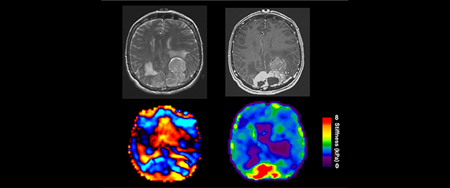 Brain glioblastoma distal from the lateral ventricle.