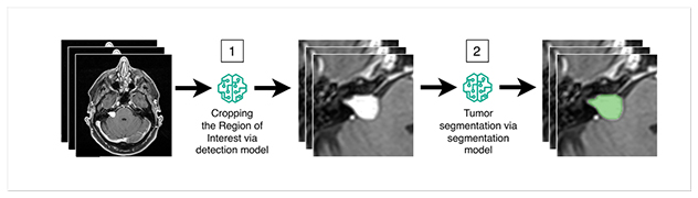 Segmentation for vestibular schwannomas