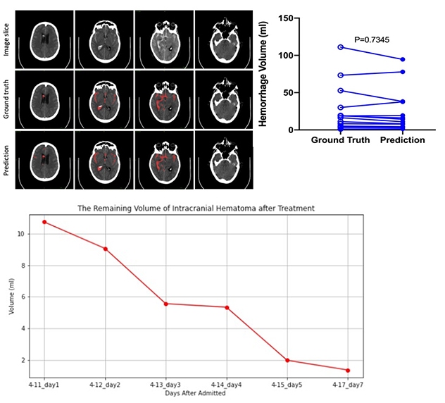 Subarachnoid hemorrhage detection on noncontrast head CT scans.