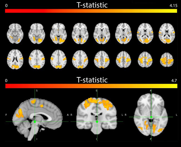 Images of brains that show differences of increased functional connectivity from the periaqueductal gray matter between patients with post-traumatic headache and healthy controls.