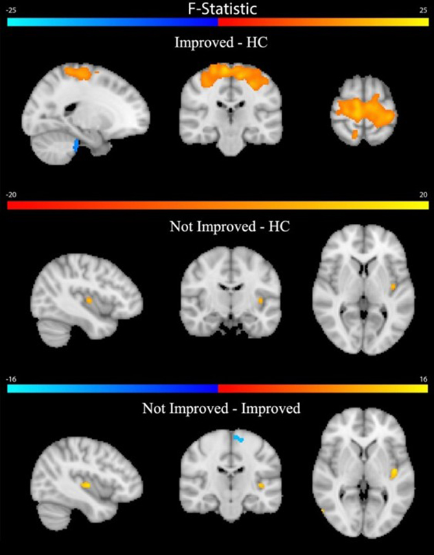 Brain images that show pairwise group differences in periaqueductal gray functional connectivity corrected for age and sex.