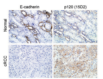 Predictive Markers Of Tumor Micrometastasis Cell Adhesion - 
